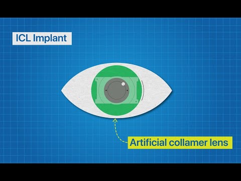 Implantable Collamer Lens (ICL Implants)