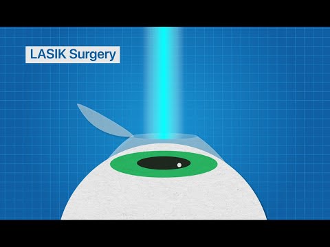 What is LASIK?