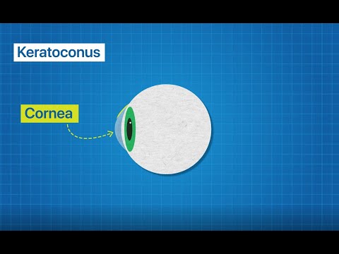 Keratoconus